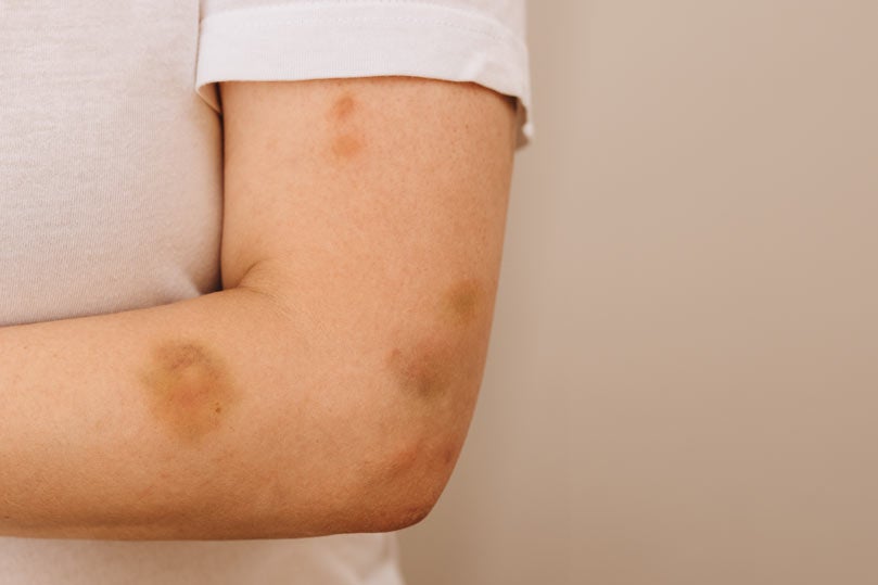 Woman's bruised arm